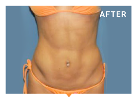 Mini Tummy Tuck San Diego La Jolla