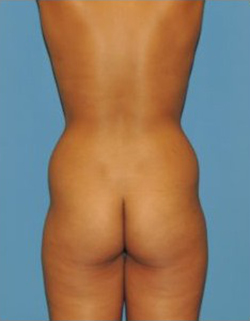 Vaser Liposuction Before & After Patient #259