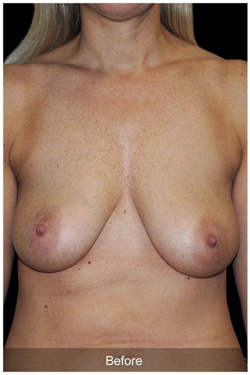 Patient #5368 Before Image