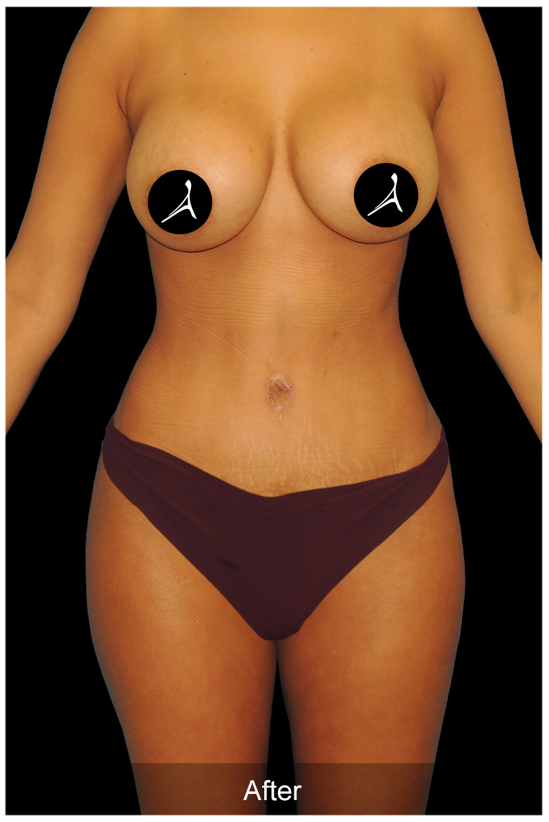 Patient #6947 After Image