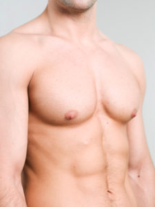 gynecomastia