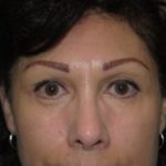 Blepharoplasty Before & After Patient #3745