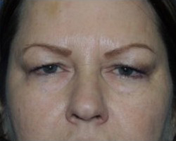 Blepharoplasty Before & After Patient #3751