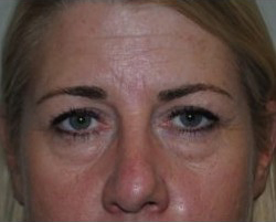 Blepharoplasty Before & After Patient #3786