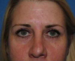 Blepharoplasty Before & After Patient #3786