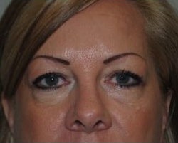 Blepharoplasty Before & After Patient #3791