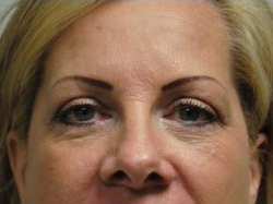 Blepharoplasty Before & After Patient #3791