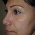 Blepharoplasty Before & After Patient #3745