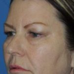 Blepharoplasty Before & After Patient #3751