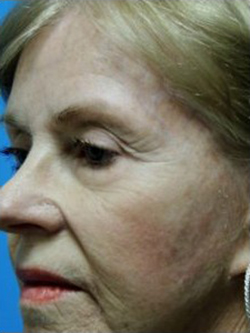 Blepharoplasty Before & After Patient #3778