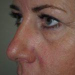 Blepharoplasty Before & After Patient #3786