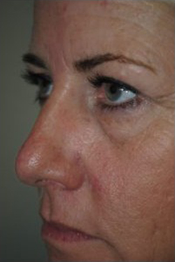 Blepharoplasty Before & After Patient #3786