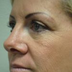 Blepharoplasty Before & After Patient #3791