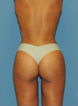 Brazilian Butt Lift Before & After Patient #83