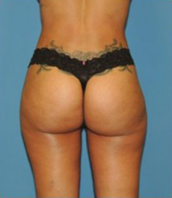 Brazilian Butt Lift Before & After Patient #88