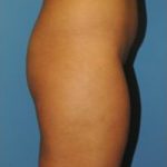 Brazilian Butt Lift Before & After Patient #83