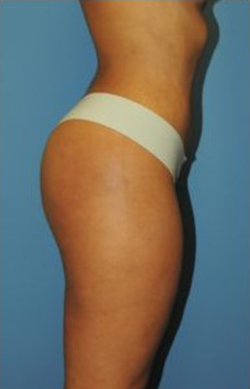 Brazilian Butt Lift Before & After Patient #83