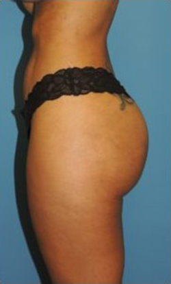 Brazilian Butt Lift Before & After Patient #88