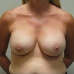 Breast Augmentation Before & After Patient #333