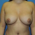 Breast Augmentation Before & After Patient #341