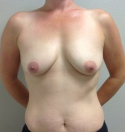Breast Augmentation Before & After Patient #362