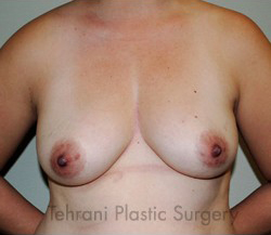 Breast Augmentation Before & After Patient #413