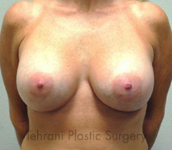 Breast Augmentation Before & After Patient #420