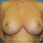 Breast Augmentation Before & After Patient #441