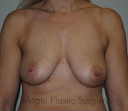 Breast Augmentation Before & After Patient #448