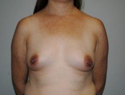 Breast Augmentation Before & After Patient #312