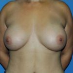 Breast Augmentation Before & After Patient #319