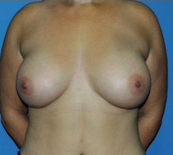 Breast Augmentation Before & After Patient #319