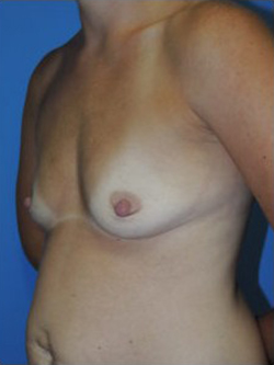 Breast Augmentation Before & After Patient #385
