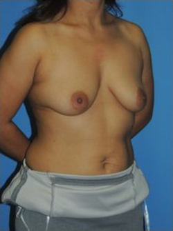 Breast Augmentation Before & After Patient #406