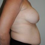 Breast Augmentation Before & After Patient #333