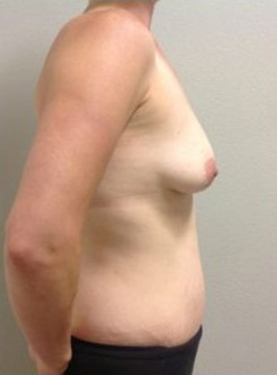 Breast Augmentation Before & After Patient #362
