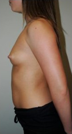 Breast Augmentation Before & After Patient #384
