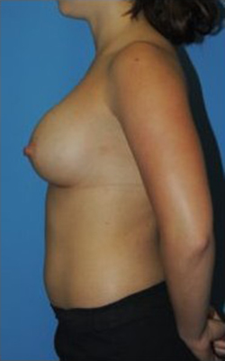 Breast Augmentation Before & After Patient #384