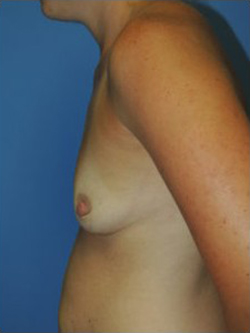 Breast Augmentation Before & After Patient #385