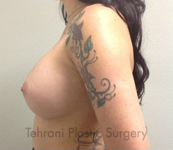 Breast Augmentation Before & After Patient #392