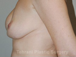 Breast Augmentation Before & After Patient #399