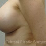 Breast Augmentation Before & After Patient #399