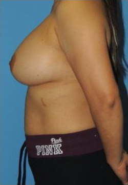 Breast Augmentation Before & After Patient #406