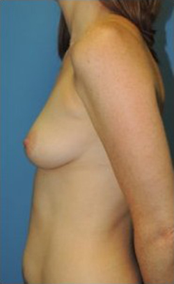 Breast Augmentation Before & After Patient #269
