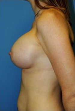 Breast Augmentation Before & After Patient #269