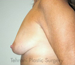Breast Augmentation Before & After Patient #420