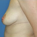 Breast Augmentation Before & After Patient #427