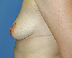 Breast Augmentation Before & After Patient #427