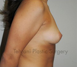 Breast Augmentation Before & After Patient #434