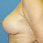 Breast Augmentation Before & After Patient #441